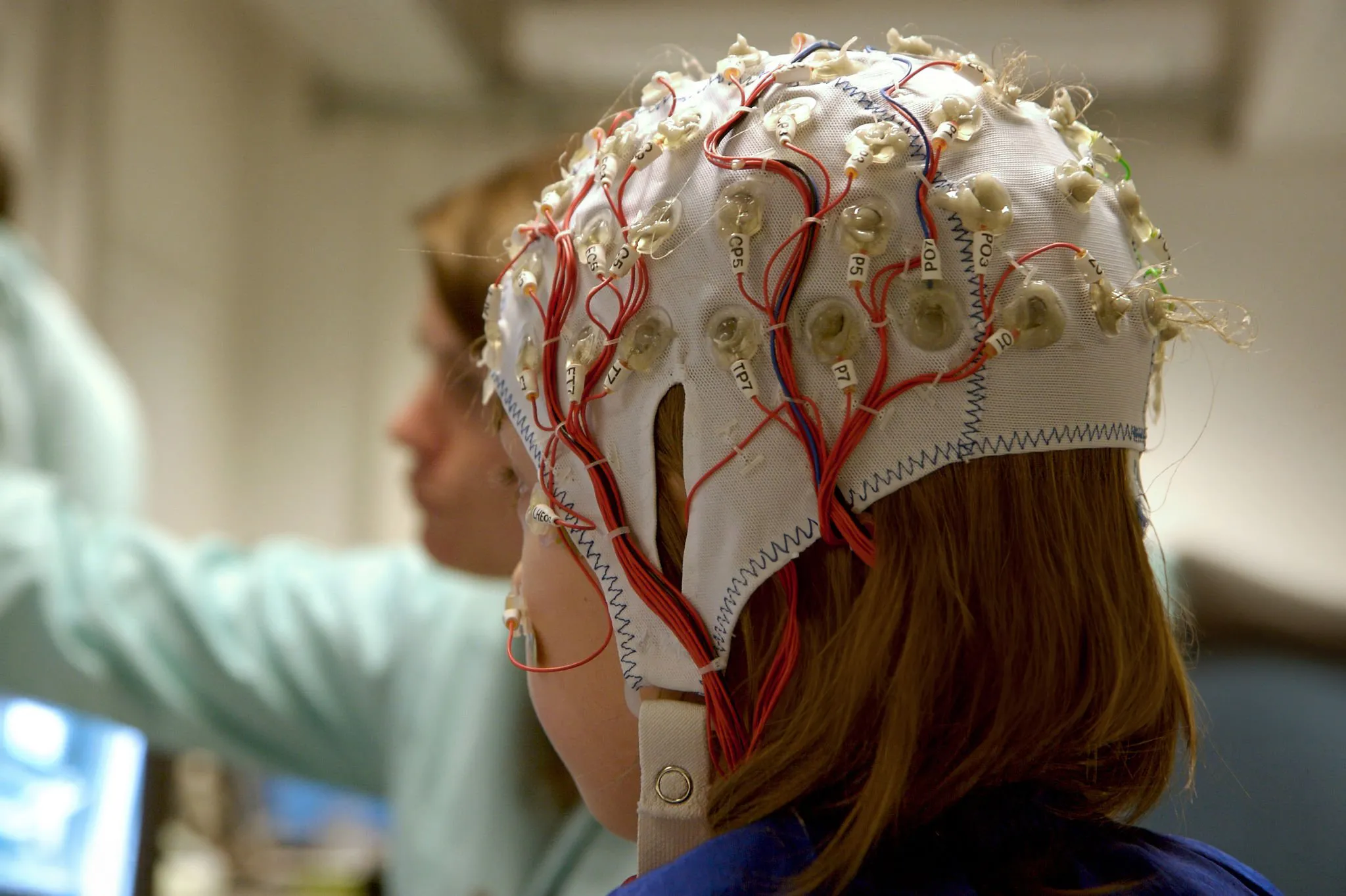 Ensayo con células madre para tratar a niños con epilepsias