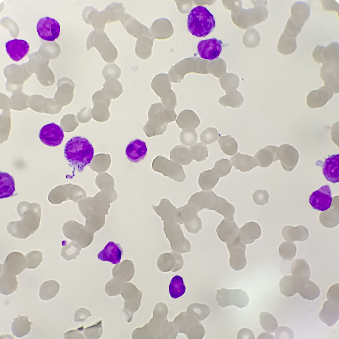 leucemia.jpg