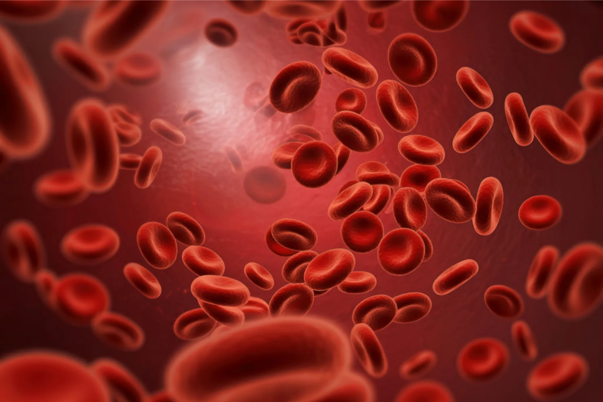 anemia aplásica severa