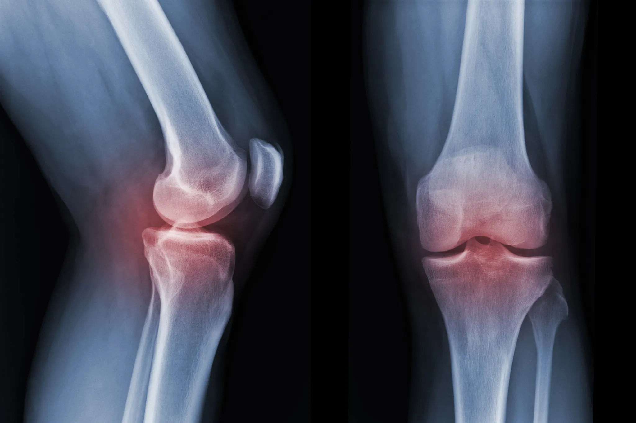 Células madre y artrosis